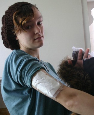 Amanda Gates shows a wounded arm and pokes her fingers through a hole in her jacket’s hood made by a dog bite. Since the thick hood covered her neck