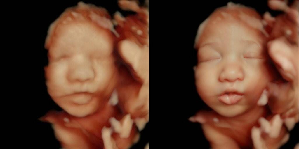 A 5D ultrasound scan of a fetus, before and after enhancement. (Photo provided)