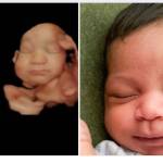 The ultrasound scan on the left was enhanced, resulting in a more detailed image (in the middle). The fetus shows a strong resemblance with its newborn sibling (on the right). (Photo provided)